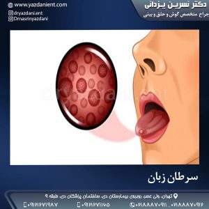 سرطان زبان - دکتر یزدانی