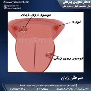 سرطان زبان