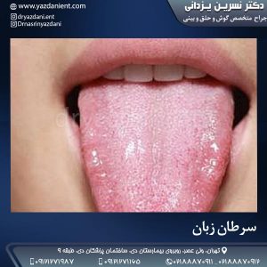 سرطان زبان