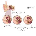 کلستاتوم همراه با فیلم