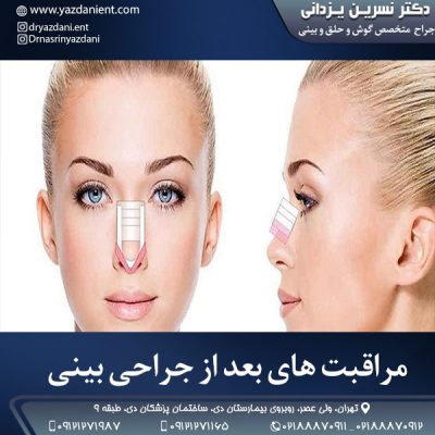 مراقبت های بعد از جراحی بینی - دکتر یزدانی