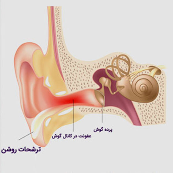 عفونت  گوش خارجی