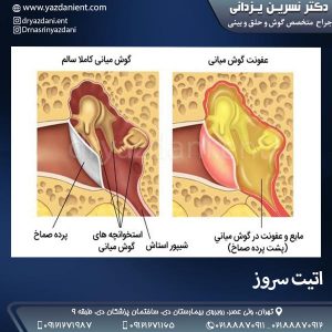 اتیت سروز- دکتر یزدانی
