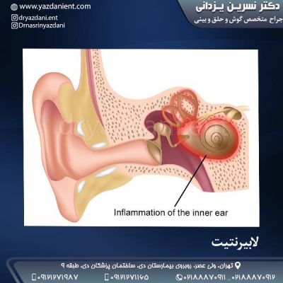 لابیرنتیت - دکتر یزدانی