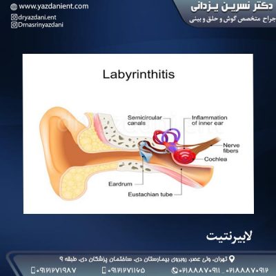 لابیرنتیت - دکتر یزدانی