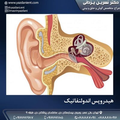 هیدروپس اندولنفاتیک - دکتر یزدانی
