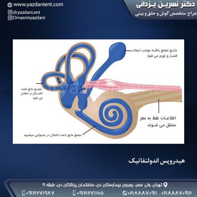 هیدروپس اندولنفاتیک - دکتر یزدانی