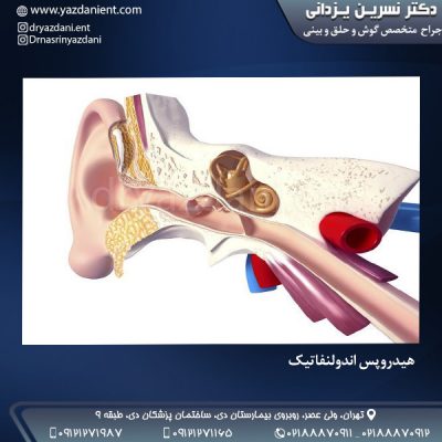 هیدروپس اندولنفاتیک - دکتر یزدانی