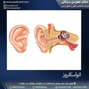 اتواسکلروز- دکتر نسرین یزدانی