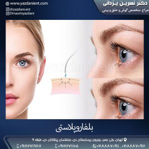 بلفاروپلاستی- دکتر یزدانی