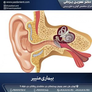 بیماری منییر- دکتر یزدانی