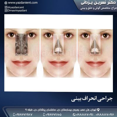 جراحی انحراف بینی - دکتر یزدانی