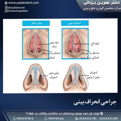 جراحی انحراف بینی - دکتر یزدانی