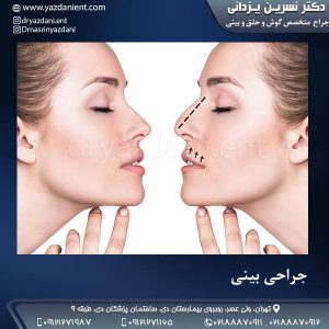 جراحی بینی- دکتر نسرین یزدانی