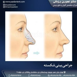 جراحی بینی شکسته - دکتر یزدانی