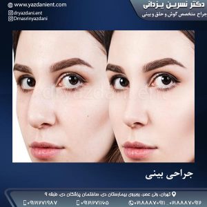 جراحی بینی- دکتر نسرین یزدانی