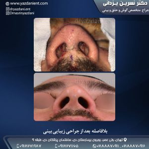 جراحی بینی