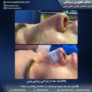 جراحی بینی