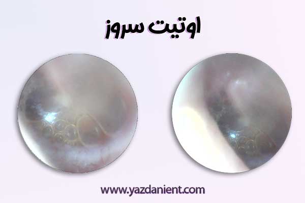 اوتیت سروز - دکتر نسریت یزدانی