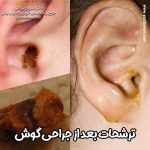 ترشحات بعد از عمل گوش