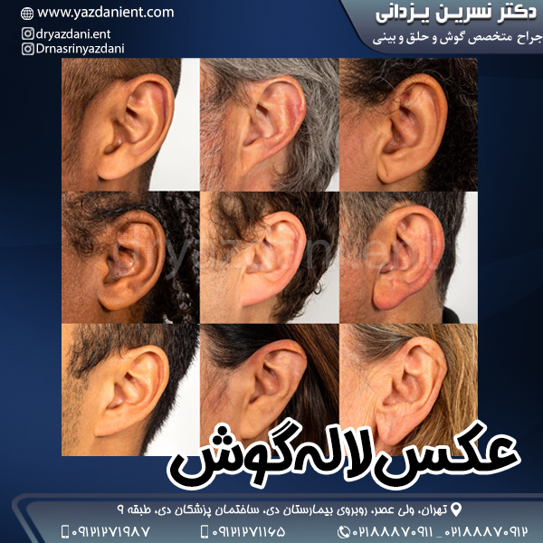 عکس لاله گوش - دکتر نسرین یزدانی