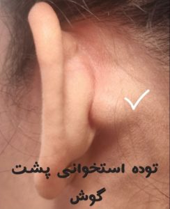 توده استخوانی پشت گوش- دکتر نسرین یزدانی