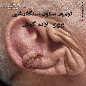 تومور سلولی سنگفرشی پشت گوش - دکتر نسرین یزدانی