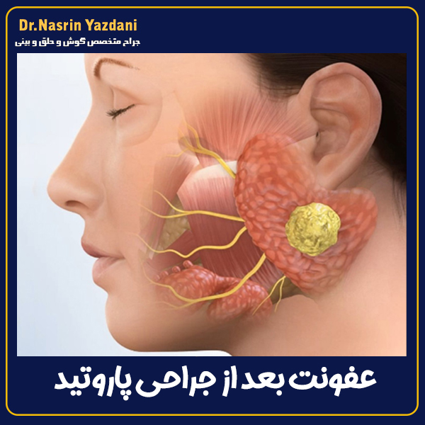 عفونت بعد از جراحی پاروتید - دکتر نسرین یزدانی