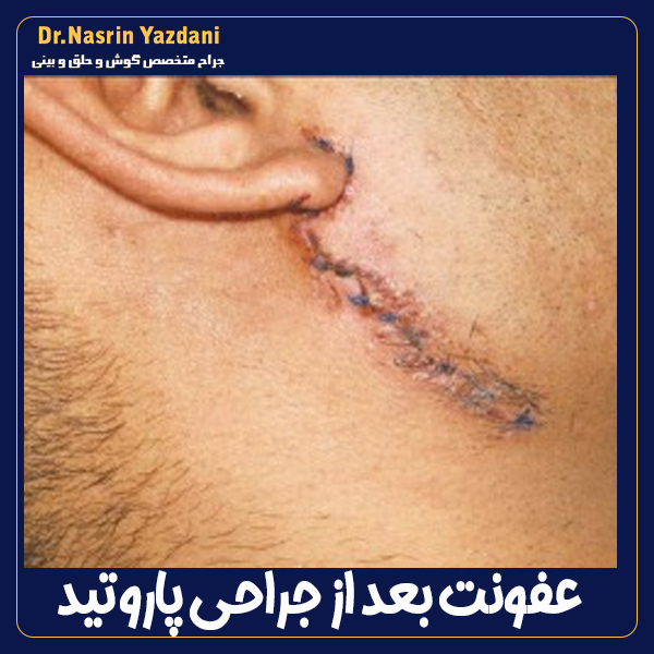 عفونت بعد از جراحی پاروتید - دکتر نسرین یزدانی