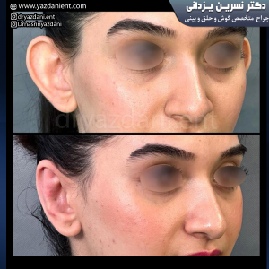 جراحی زیبایی گوش - دکتر نسرین یزدانی