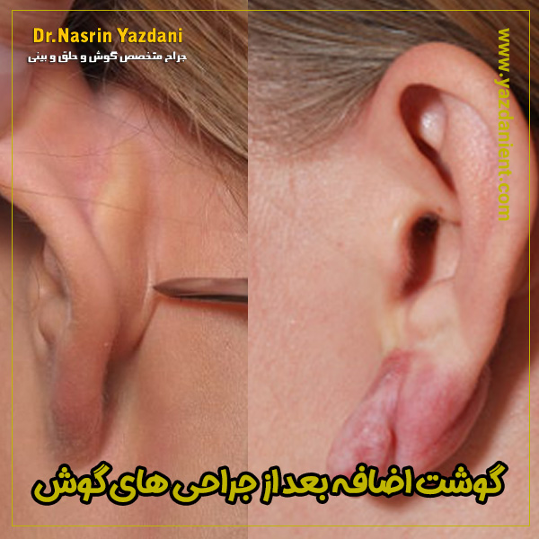 کلوئید و گوشت اضافه بعد از جراحی گوش - دکتر نسرین یزدانی