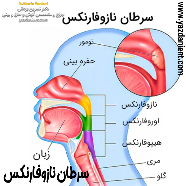 سرطان نازوفارنکس- دکتر نسرین یزدانی