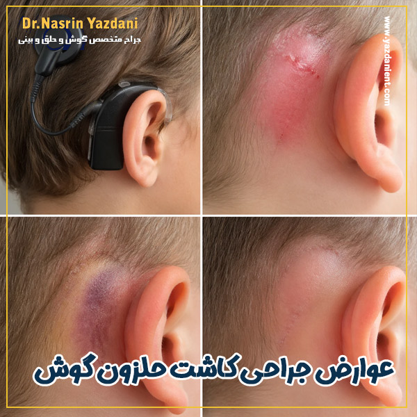 عوارض کاشت حلزون گوش - دکتر نسرین یزدانی
